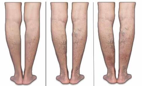 Etapas de varices