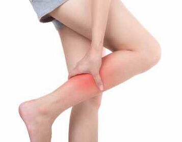 Síntomas de varices