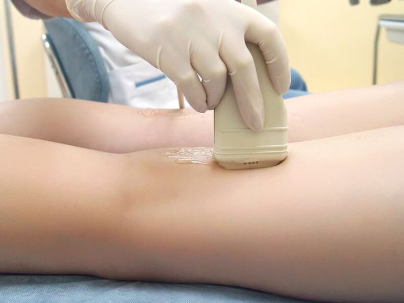 Tratamento de varices