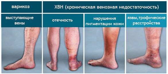 Etapas de varices