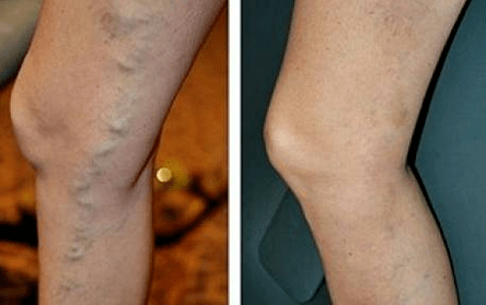 varices vas antes e despois