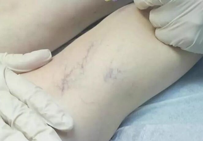Complicacións despois da cirurxía