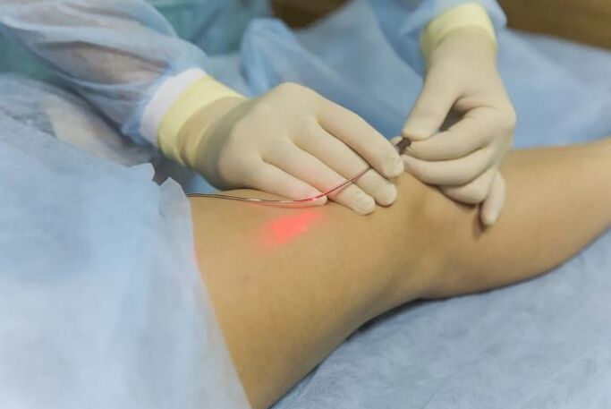 Tratamento de varices cun láser