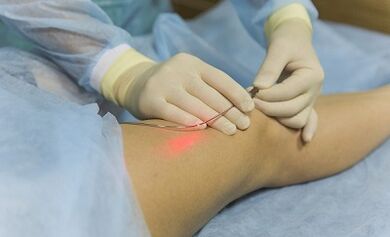 Tratamento de varices cun láser
