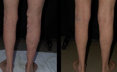 Tratamento de varices cunha foto láser antes e despois